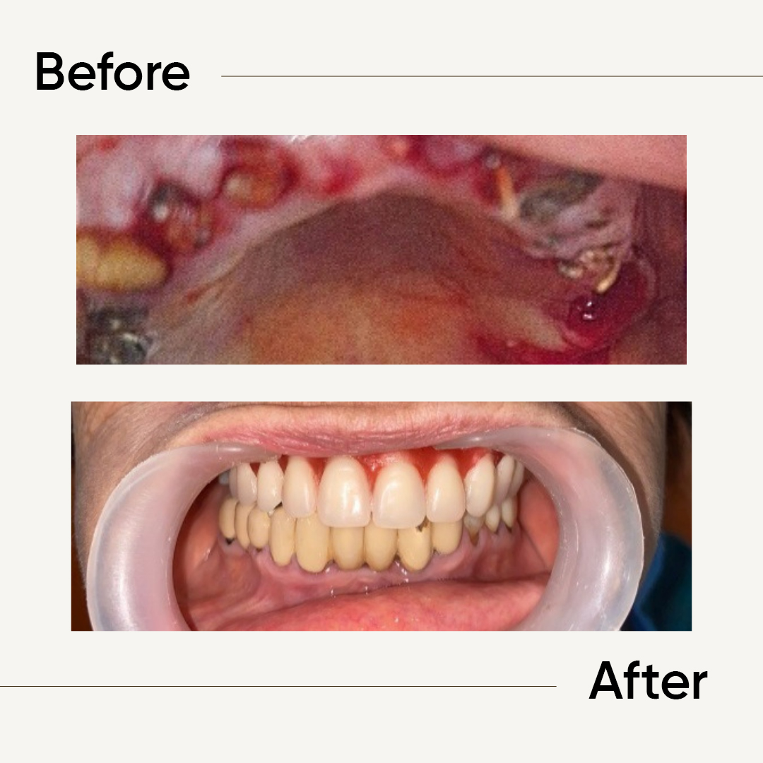 Before After 6
