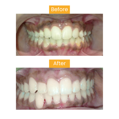 Before After 2