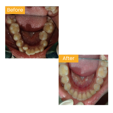 Before After 3