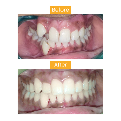 Before After 3