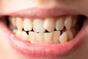 Crossbite