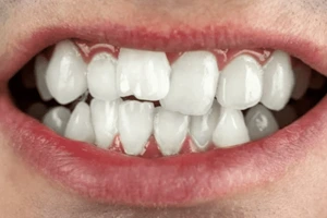 Crowded Teeth
