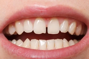 Gapped Teeth