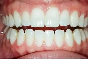 Open Bite
