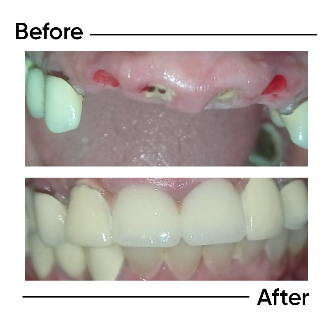Before After 1