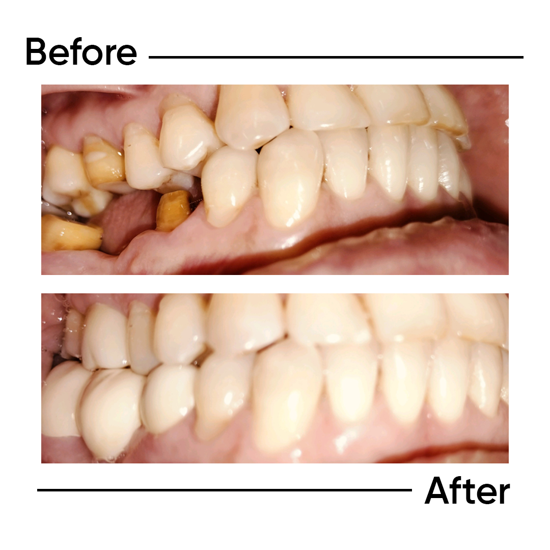 Before After 2