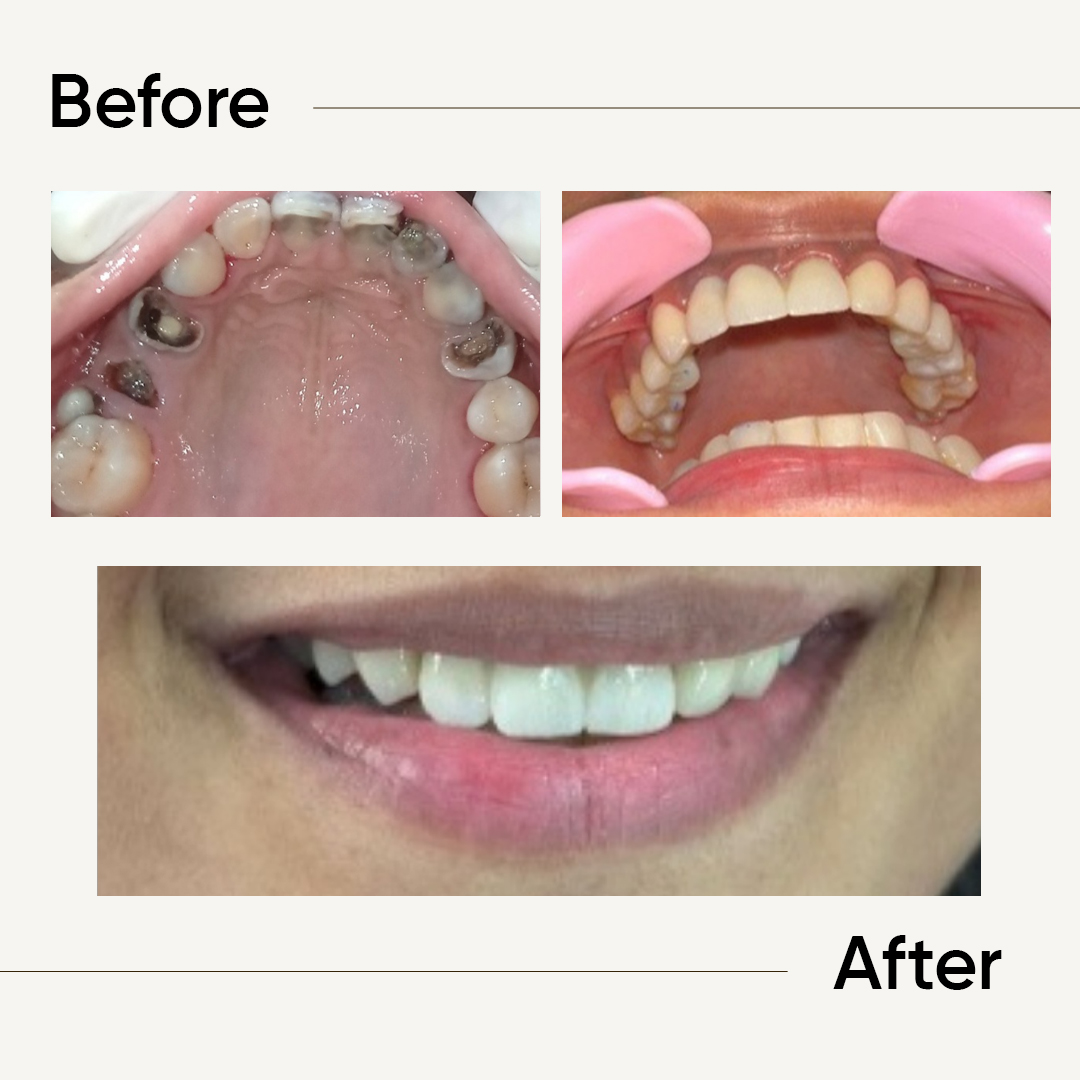 Before After 3