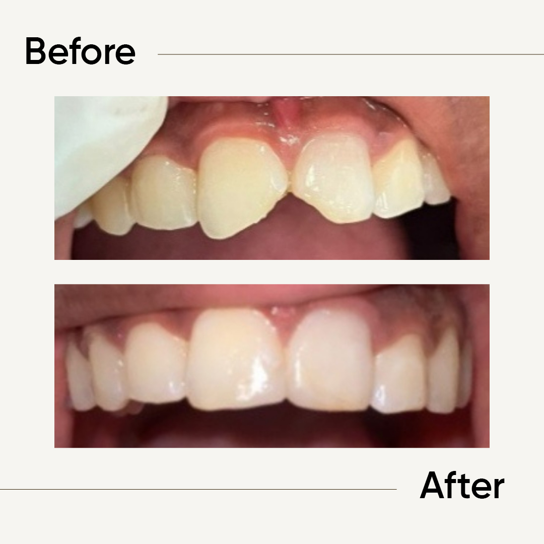 Before After 4