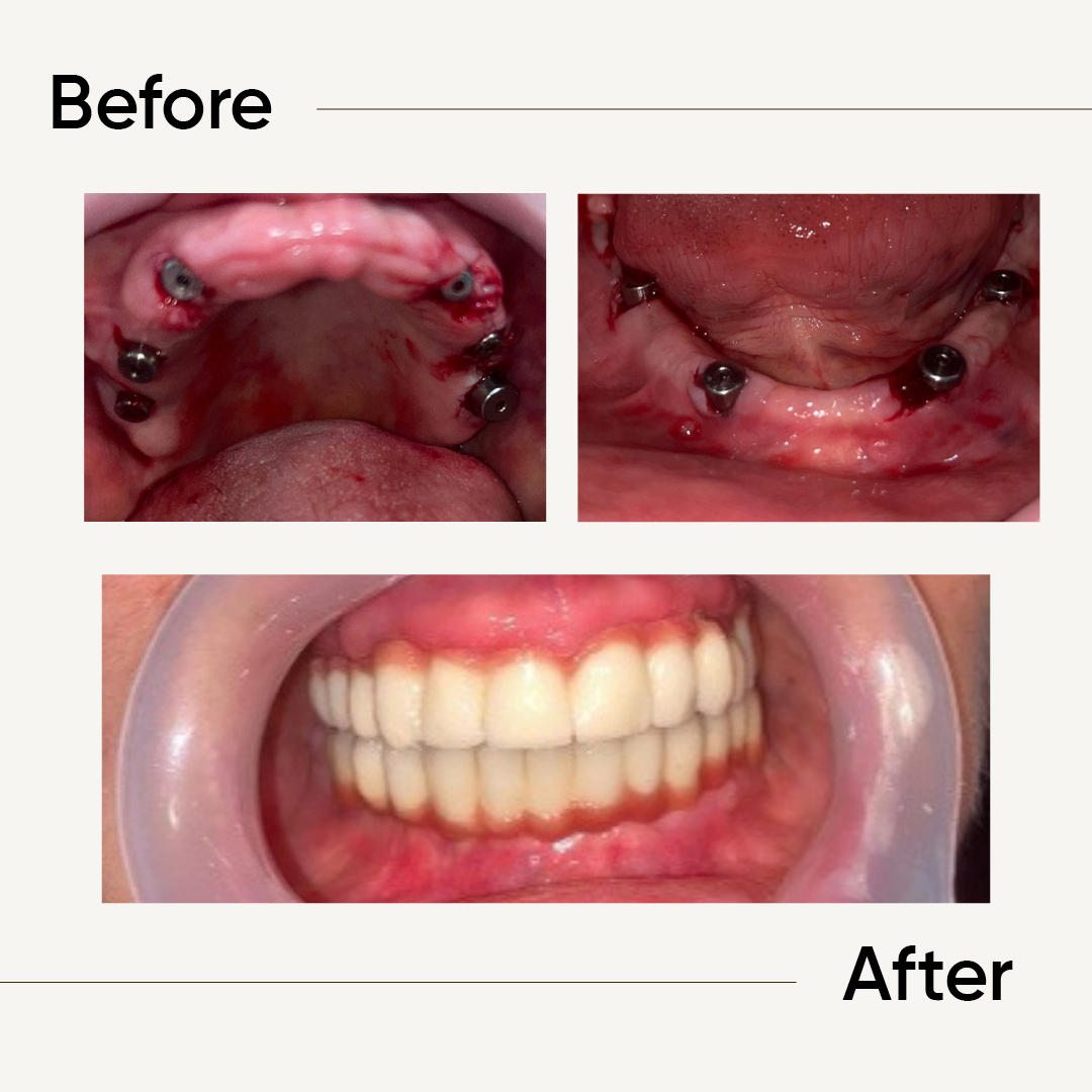 Before After 5