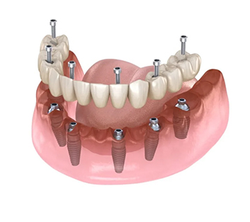 All-on-4 Implants