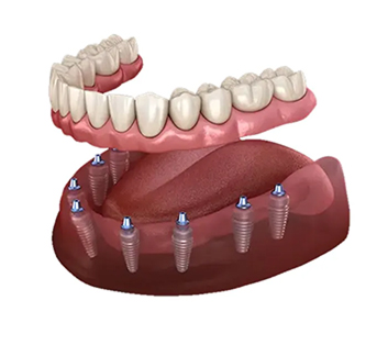 All-on-6 Implants