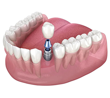 Single Tooth Implant